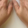 Yaluronica Before Effect